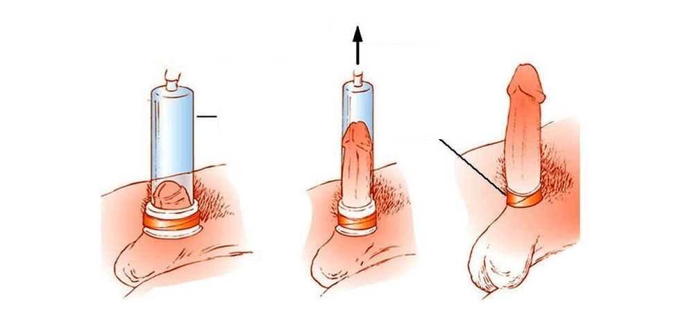 hur en vakuumpump för penisförstoring fungerar