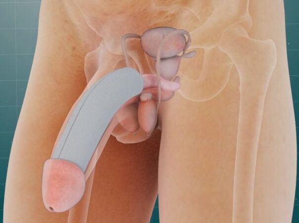 Penis efter införandet av ett speciellt implantat under huden